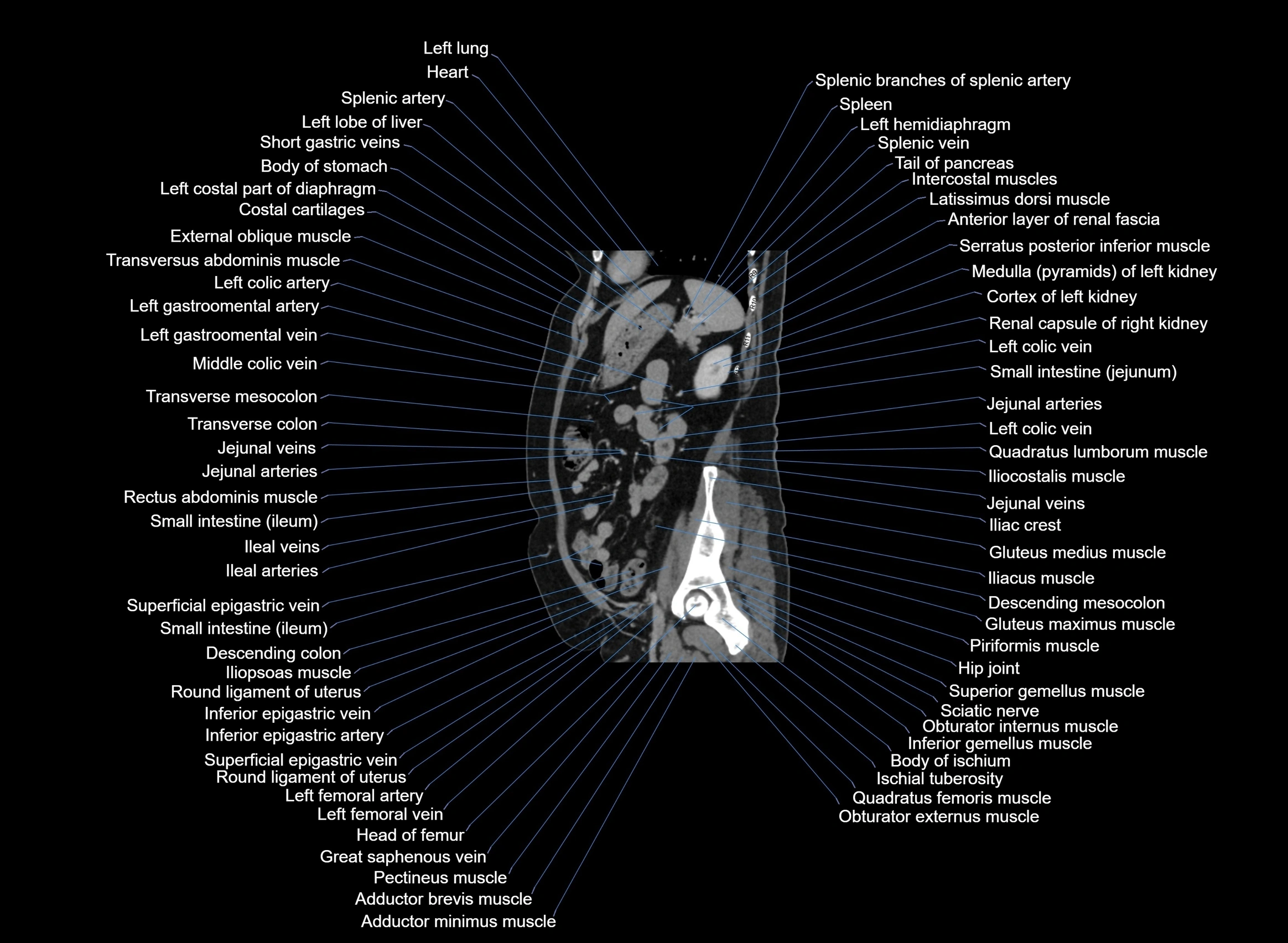 CT Abdomen sagittal cross sectional anatomy labelled radiology image -00034.webp